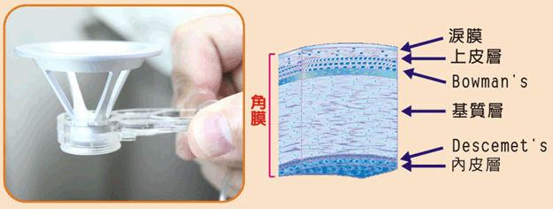 角膜瓣製作技術