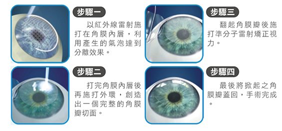 SUPRACOR 飛秒準分子老花雷射原理