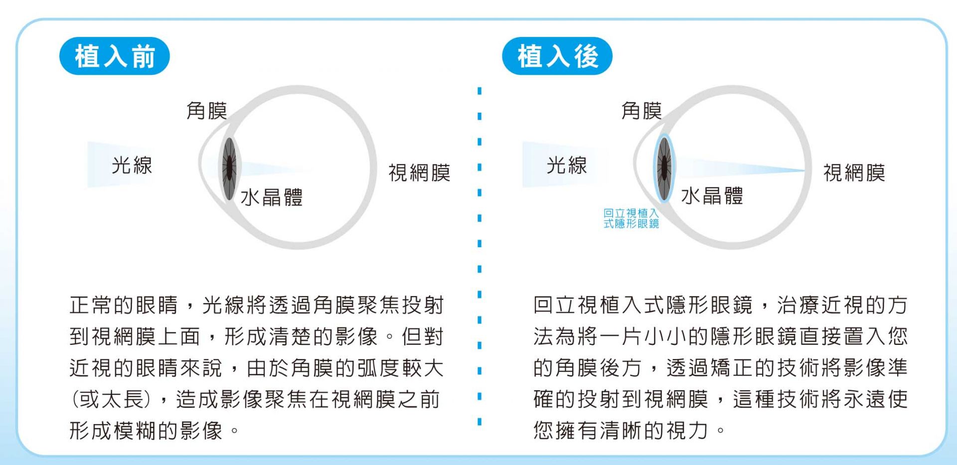 植入式微型鏡片