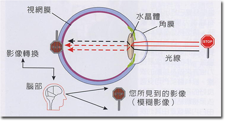 白內障原理