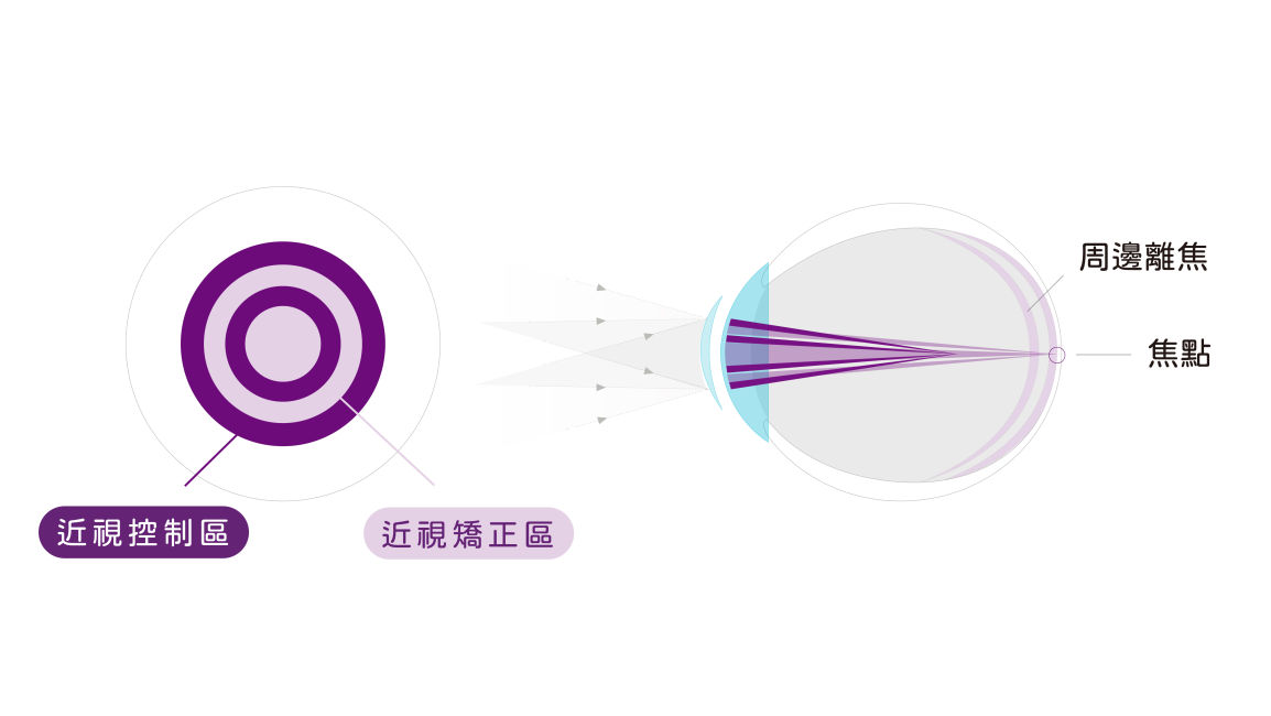學童近視控制日拋隱形眼鏡原理