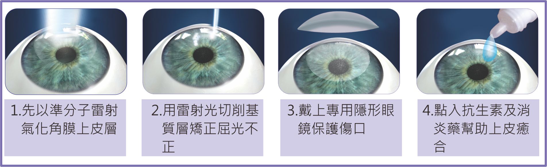 Trans PRK原理