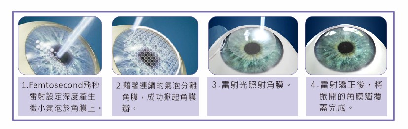 飛秒雷射角膜層狀重塑術