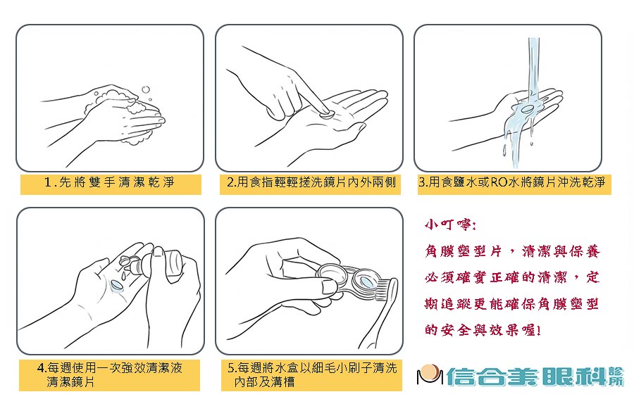 角膜塑形術(OK鏡片)的保養清潔
