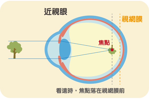 近視眼